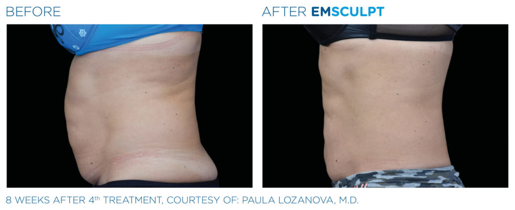 emsculpt-before-and-after