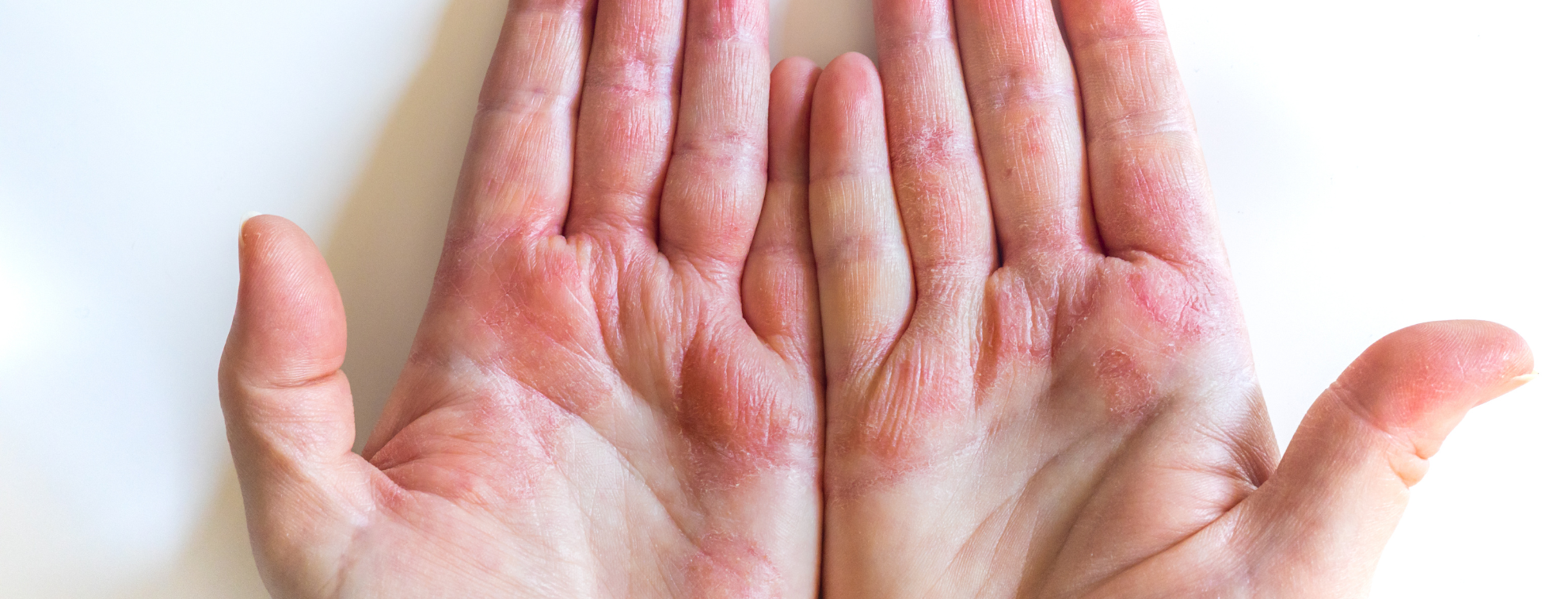 Eczema: It’s far more than skin deep!